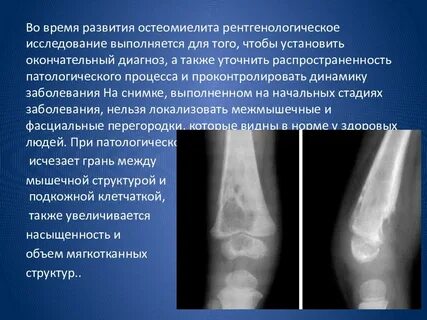 Остеомиелит кости признаки