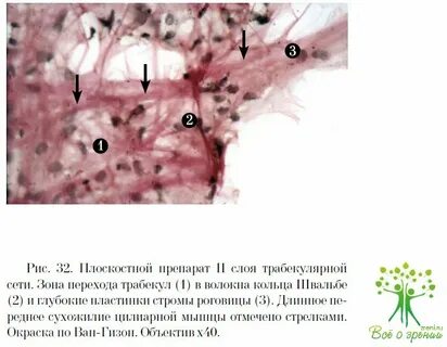 Зона трабекулярного отека