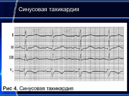 Синусовая тахикардия эос вертикальная