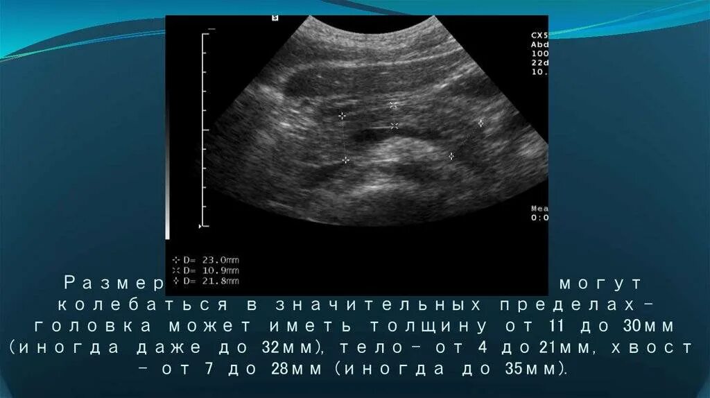 Признаки реактивных изменений поджелудочной. Нормы размеров поджелудочной железы по УЗИ У взрослых. Размер поджелудочной железы у детей по УЗИ. УЗИ поджелудочной железы у детей норма. Размер головки поджелудочной железы.