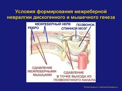 Межреберная невралгия спины слева