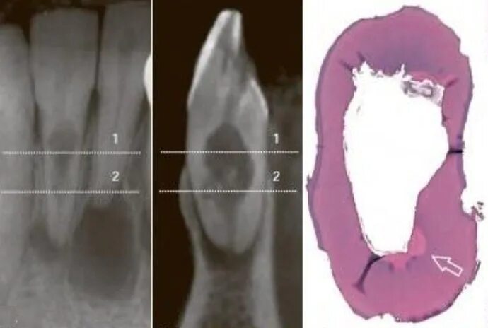 Наружная резорбция корня зуба. Пришеечная резорбция корня. Патологическая резорбция корня. Воспалительная резорбция корня зуба.