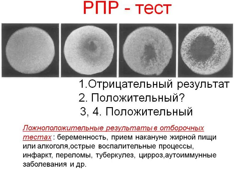 Положительный результат пробы. Исследование крови RPR+РПГА. Положительный результат на сифилис. Реакция микропреципитации сифилис. Интерпретация результатов РПГА на сифилис.