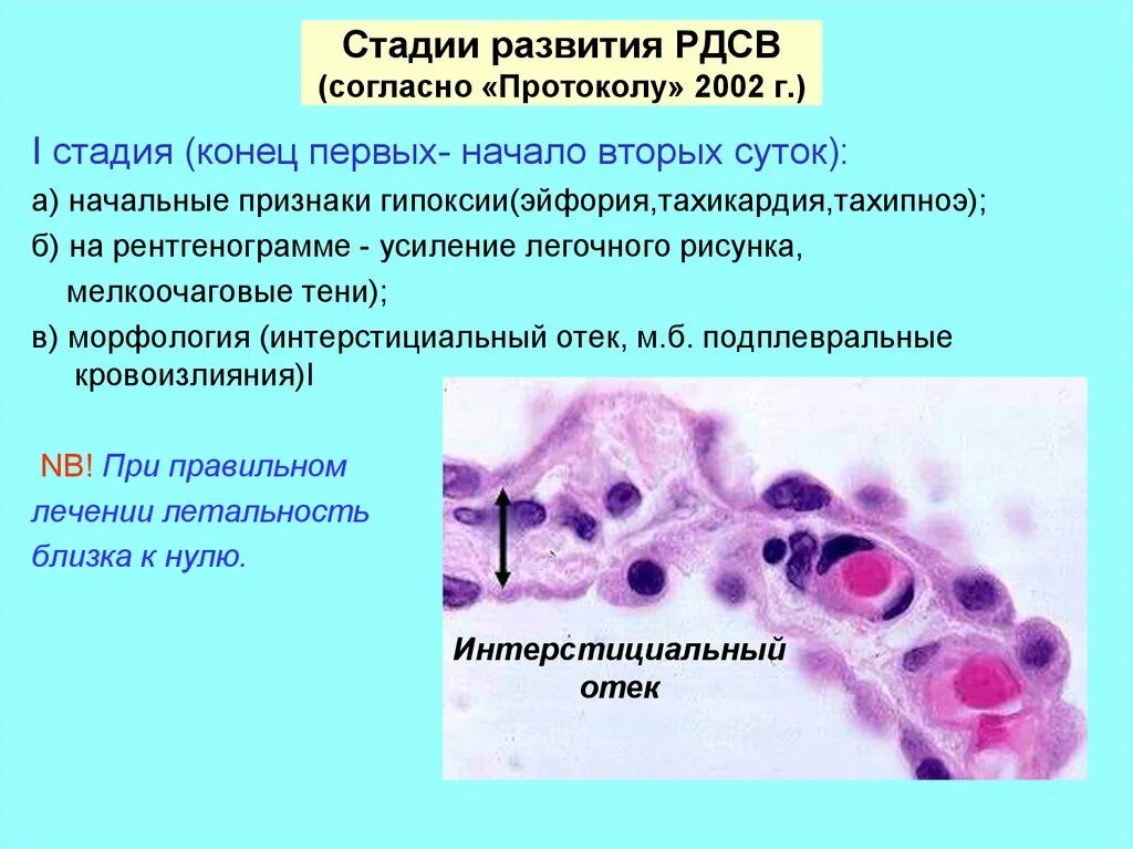 Респираторный дистресс взрослых. РДС синдром взрослых патанатомия. Острый респираторный дистресс синдром патанатомия. Респираторный дистресс синдром взрослых патанатомия. Респираторный дистресс-синдром взрослых гистология.