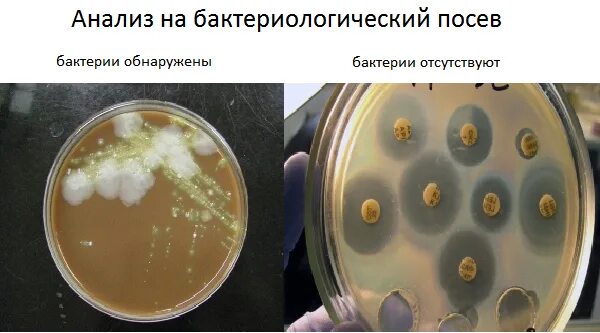 Мокрота при инфекции. Бактериологический посев мокроты. Микроскопическое и бактериологическое исследование мокроты. Культуральное исследование мокроты. Бактериологическое исследование мочи (посев мочи).