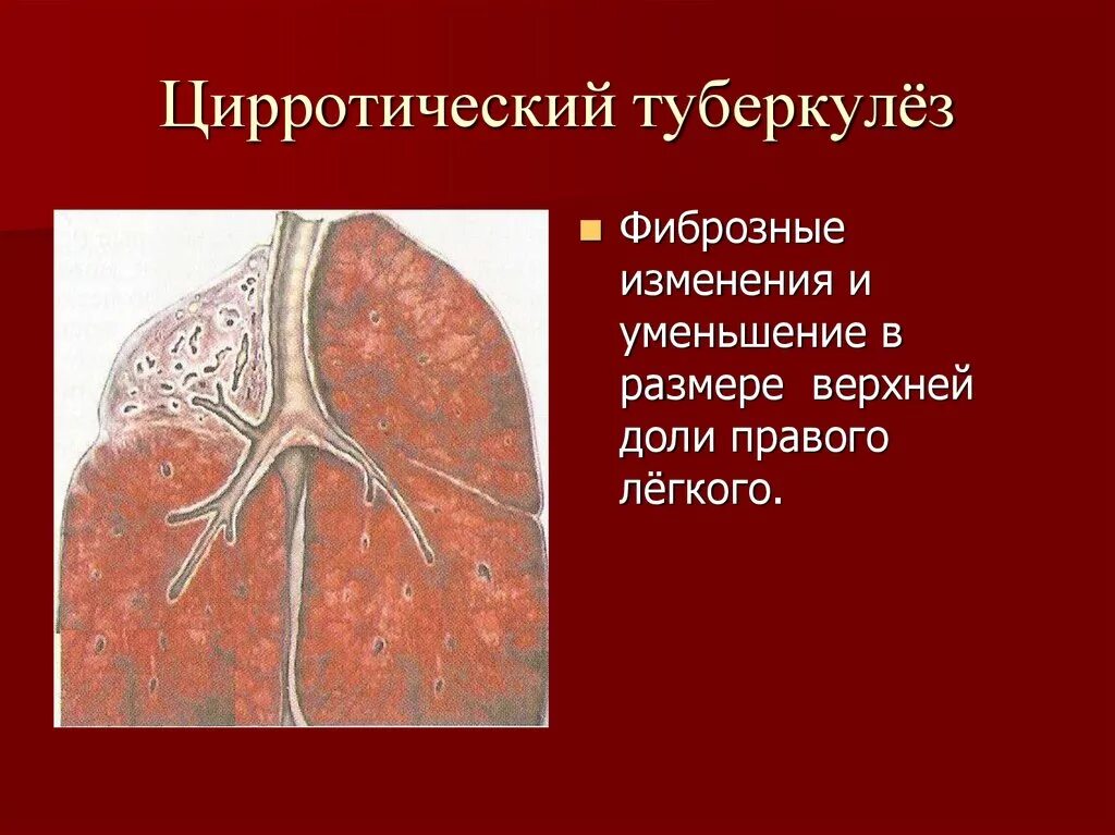 Как сделать туберкулез. Цирротический туберкулёз фтизиатрия. Кавернозный туберкулез фтизиатрия. Цирротический туберкулез легких. Цирротический туберкулёз лёгких.