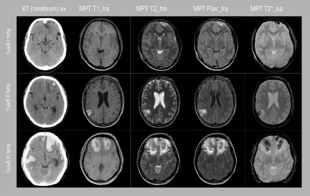 Мрт при сотрясении. Ушиб головного мозга на мрт стадии. Ушиб головного мозга кт мрт. Мрт головного мозга с СГМ.