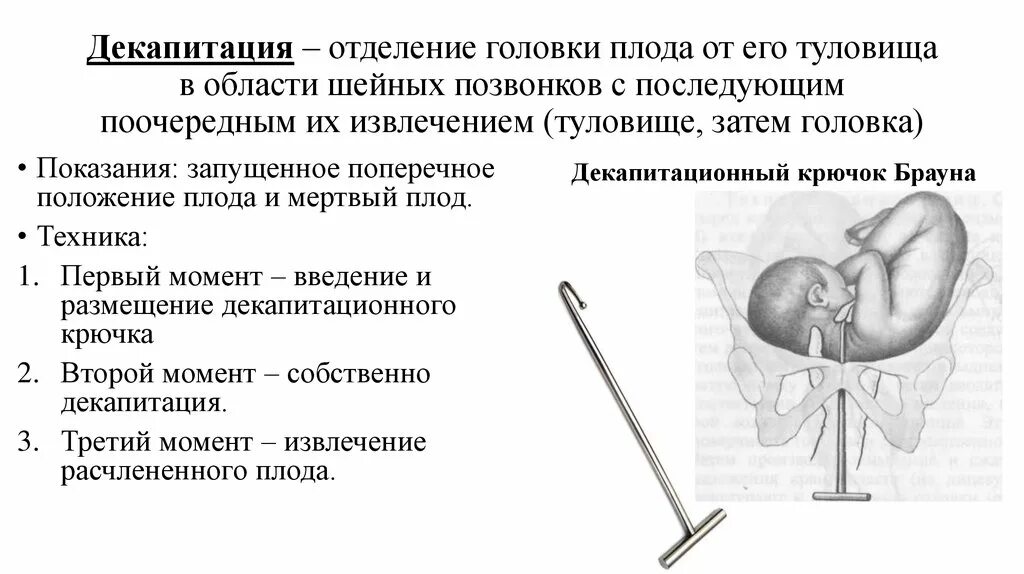 Декапитационный крючок Брауна. Плодоразрушающая операция декапитация. Плодоразрушающие акушерские операции. Декапитация плода инструментарий. Разрушающие операции