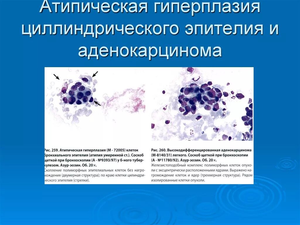 Клетки без признаков атипии. Пролиферации железистого эпителия цитология. Гиперплазия железистого эпителия цитология. Гиперплазированный железистый эпителий. Атипические клетки железистого эпителия.