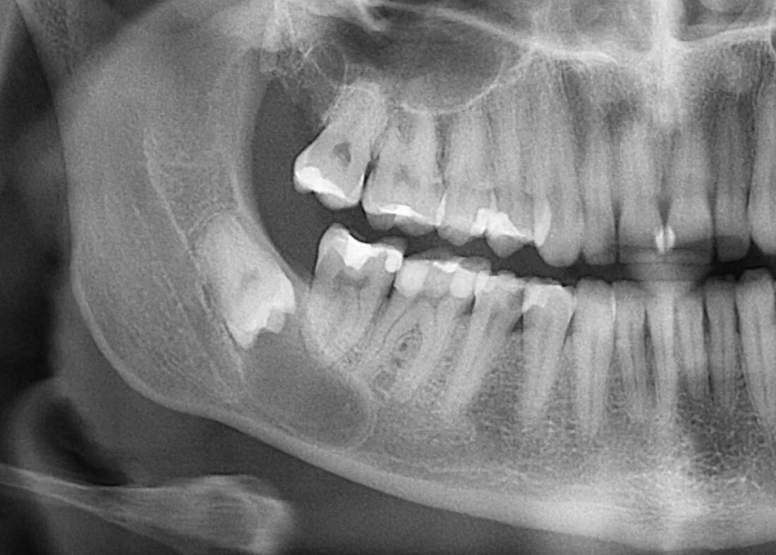 Зуб 8 нижний. Ретинированный зуб мудрости рентген. Ретенированный премоляр. Ретинированного дистопированного зуба. Ретинированный дистопированный зуб.