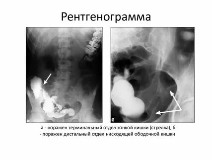Терминальный илеит это