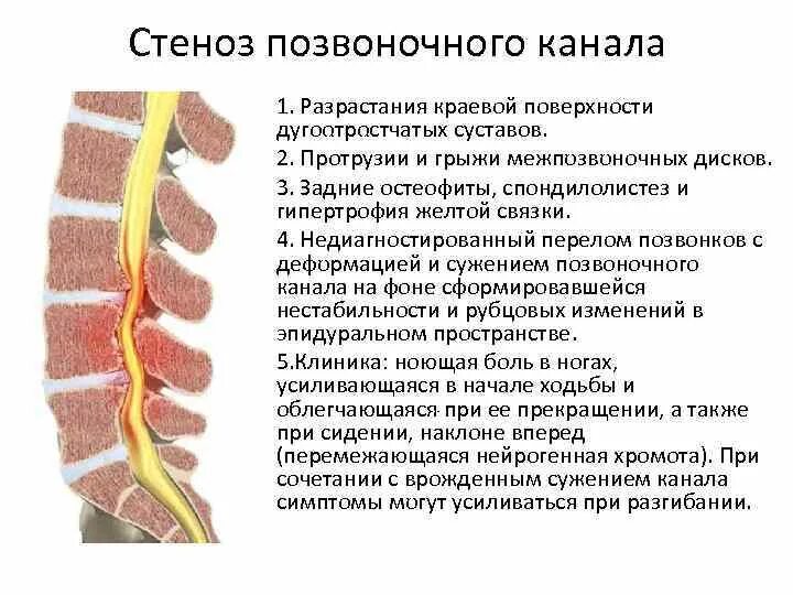 Можно ли грыжи дисков