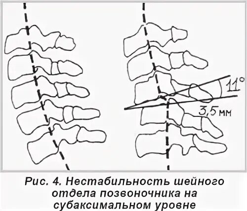 Сегмент с2 с3. Нестабильность сегмента с3-с4. нестабильность с3 с4 с5 шейных позвонков. функциональная нестабильность шейного отдела позвоночника с3-4-5. нестабильность сегмента с1-с2.