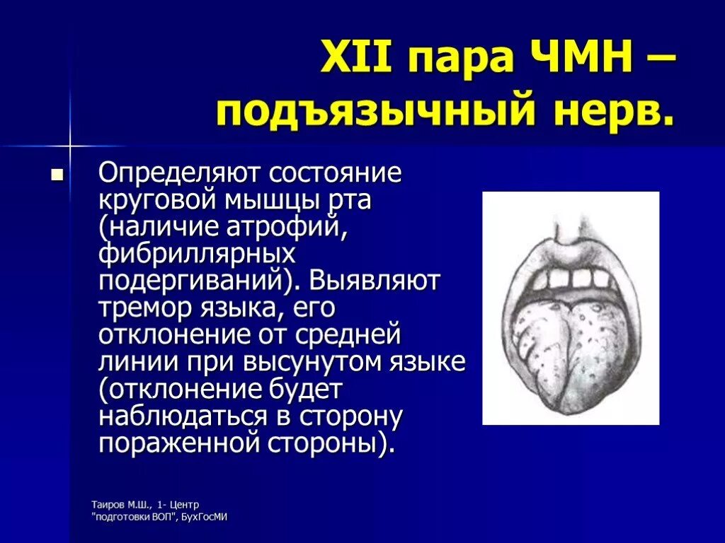 XII пара - подъязычный нерв. Отклонение языка в сторону. Атрофия латынь