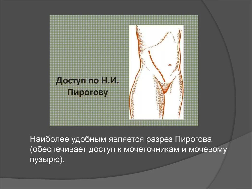 Вскрытие псоас абсцесса. Разрез по пирогову. Внебрюшинно (доступом по пирогову. Дренирование абсцесса червеобразного отростка. Хирургические доступы к забрюшинному пространству.