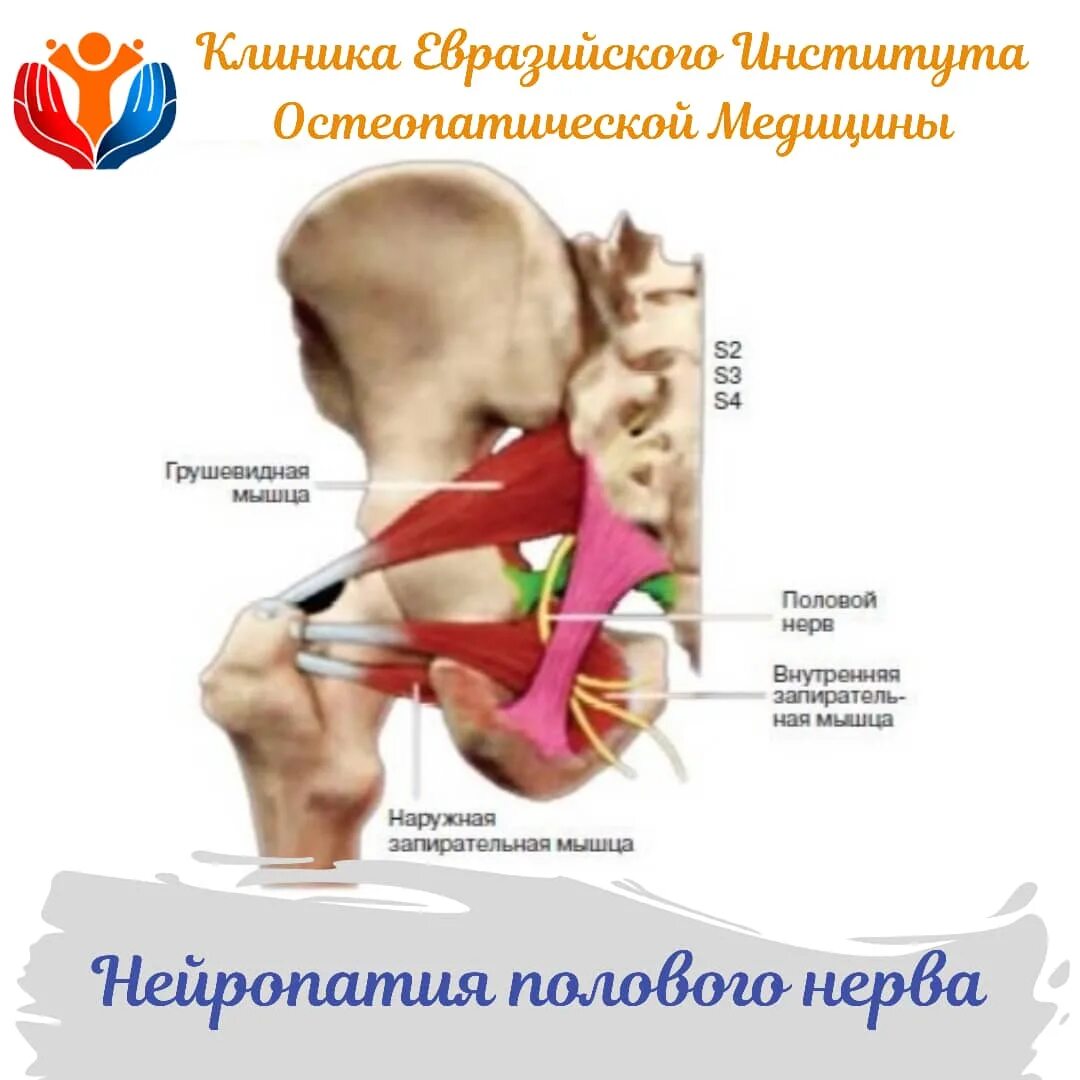 Половой нерв у мужчин симптомы. Половой нерв нейропатия. Нейропатия полового нерва у женщин. Нейропатия полового нерва упражнения. Нейропатия срамного нерва у женщин.