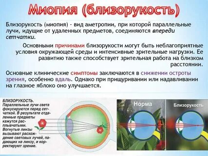 Миопия средней степени h 52.1