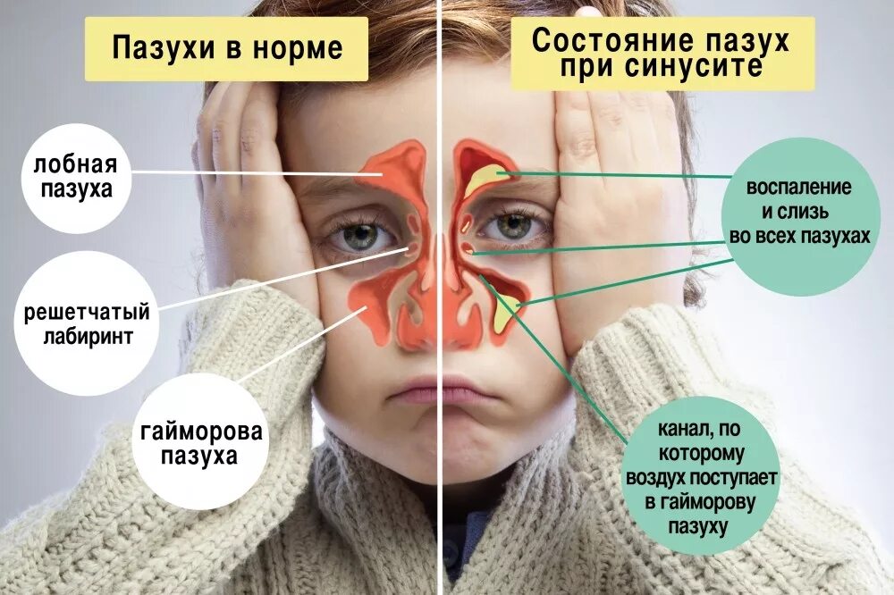 Что такое фронтит