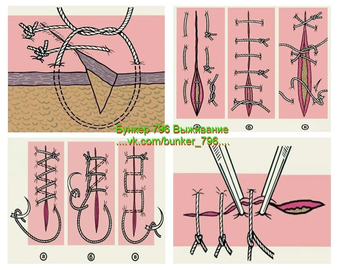 Техника наложения хирургических швов. Наложение хирургических швов Ветеринария. Как накладывать швы хирургия. Виды хирургических швов топографическая анатомия.