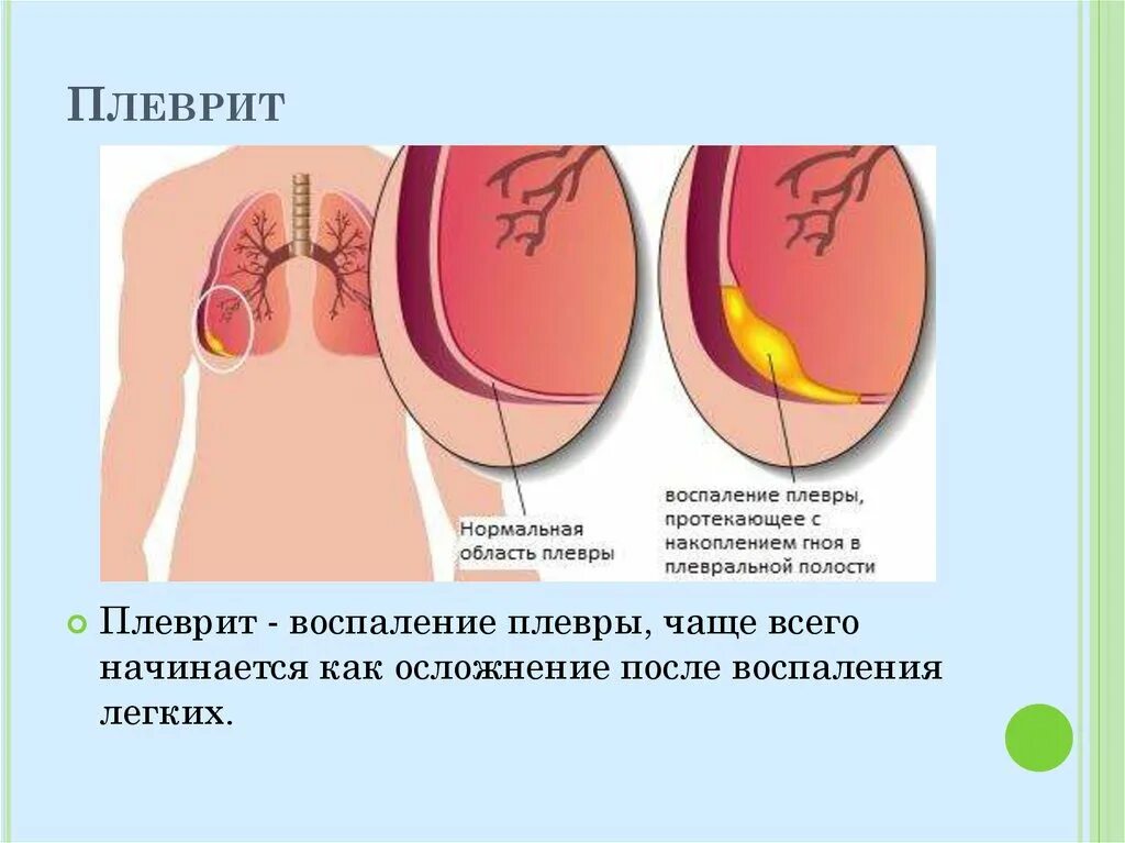 Осложнения после воспаления. Воспаление листков плевры.