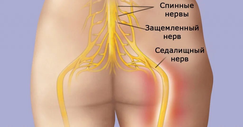 Почему болит поясница и ноги. Седалищный нерв анатомия схема. Защемление седалищного нерва. Седалищный нерв ягодичный нерв. Анатомия. Седалищный нерв в ягодице.