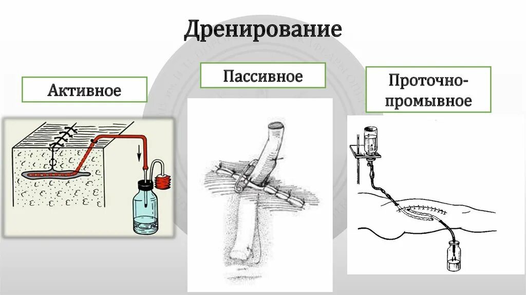 Пассивное дренирование РАН. Дренирование пассивное активное проточно-промывное. Активный и пассивный дренаж в хирургии. Пассивное и активное дренирование РАН. Установка антисептика