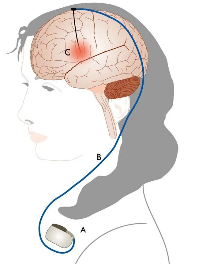 Стимулятор блуждающего нерва. DBS стимулятор при эпилепсии. Электроды в головной мозг. Электростимуляция мозга. Нейростимуляция затылочного нерва.