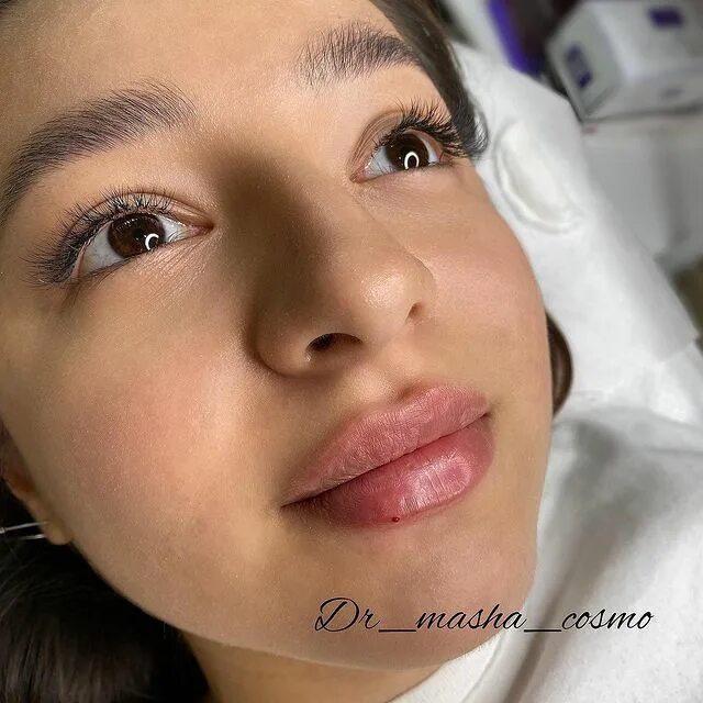 губы косметология. красивое увеличение губ. контурирование губ гиалуроновой кислотой. косметолог губы спб. косметолог губы спб.