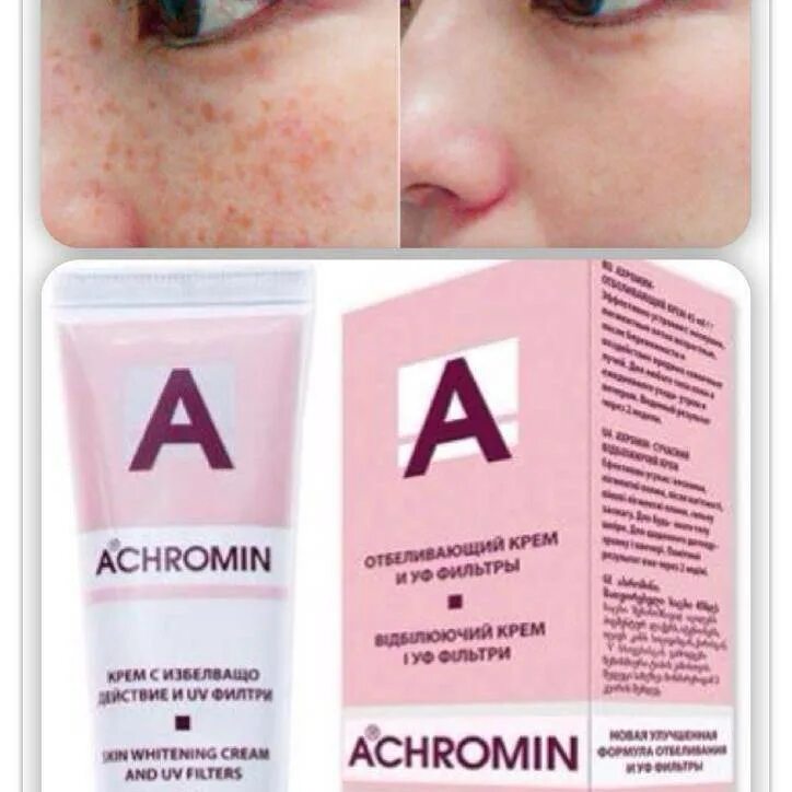 Ахромин крем отбеливающий. Крем ахромин от пигментных пятен. Отбеливающий крем для лица от пигментных ахромин. Ахромин крем отбеливающий до и после.