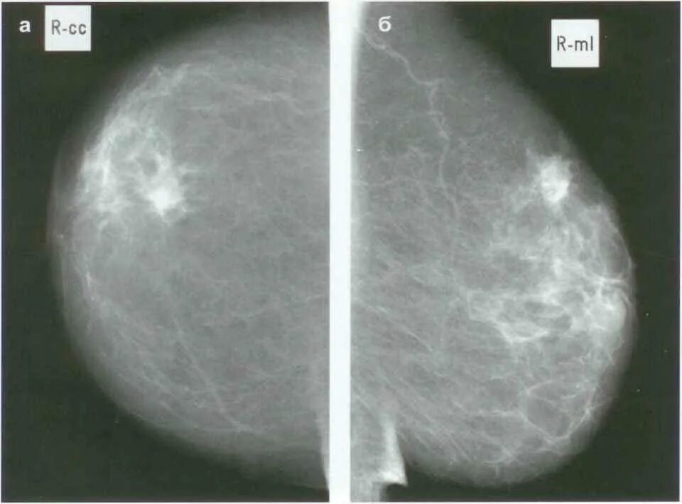 Диффузный фиброаденоматоз молочных желез что это такое. Маммография фиброаденома. Узловая мастопатия молочной железы маммография. Фиброаденома молочной железы маммография. Фиброзно-кистозная мастопатия снимок.