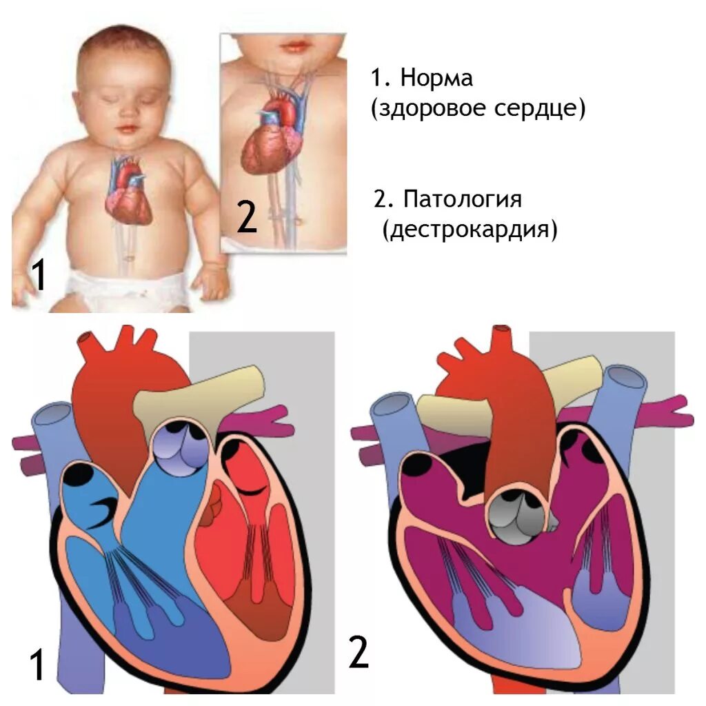 Сердце ребенка. Расположение сердца у детей.