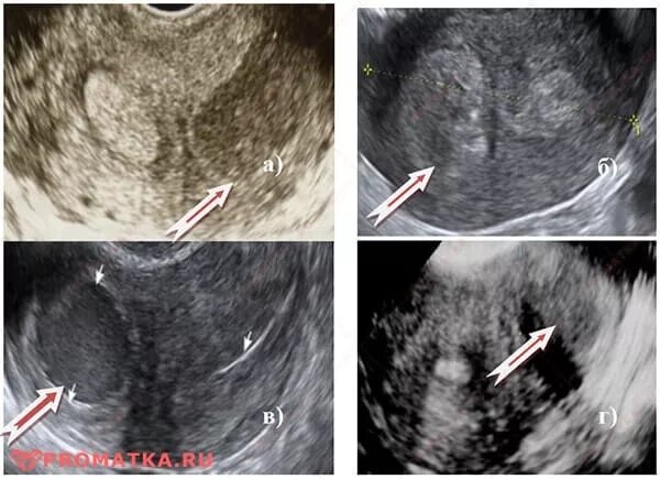 Эхопризнаки аденомиоза что это. Эндометриоз аденомиоз матки. Аденомиоз в эндометрии.