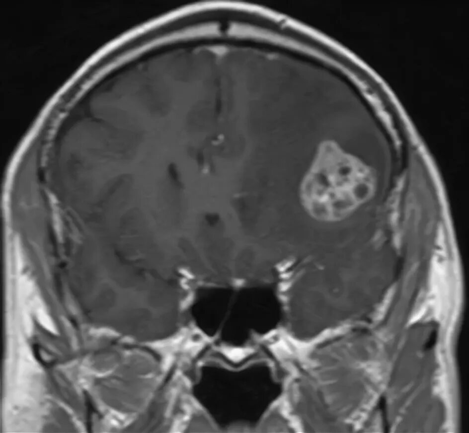 Метастазы в головном мозге на кт. Рак легких метастазы в мозг сколько. Метастатические опухоли мозга. Гематогенные метастазы в кости. Метастазы в лёгких и мозге.