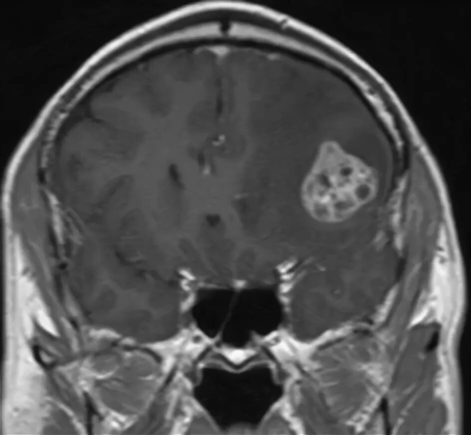 Лечение метастазов мозга. Метастаз в правой лобной доле. Метастаз в лобной части головы.