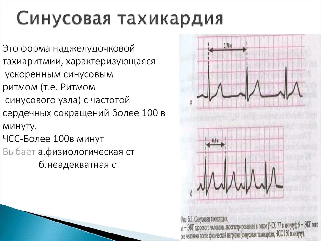 Что делать при тахикардии в домашних условиях. Синусовая тахикардия препараты. Синусовая аритмия на ЭКГ. Синусовая тахикардия на ЭКГ. Синусовая аритмия тахикардия.