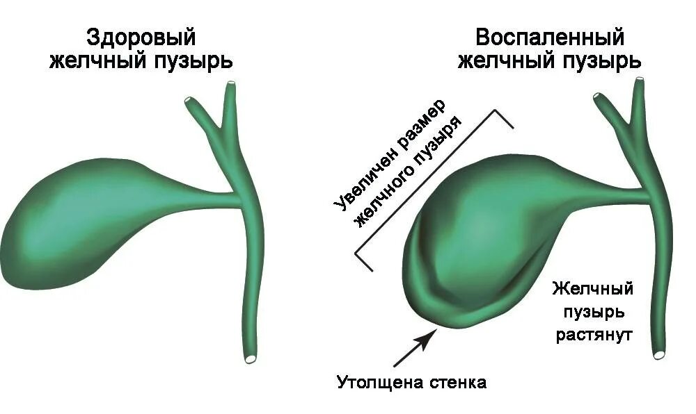Загиб желчного протока. Перегиб желчного пузыря. дискинезия желчевыводящих путей это перегиб.