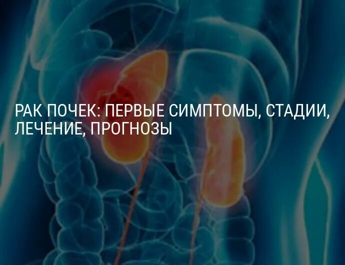 Первые симптомы онкологии почек. Онкология почки симптомы. Симптомы онкологии почек у мужчин. Опухоль почек у женщин