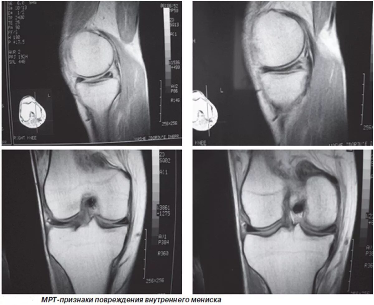 Изменение внутреннего мениска. Разрыв мениска коленного сустава снимок. Мрт коленного сустава разрыв мениска. Разрыв мениска коленного сустава симптомы. Мениск разрыв мениска симптомы.