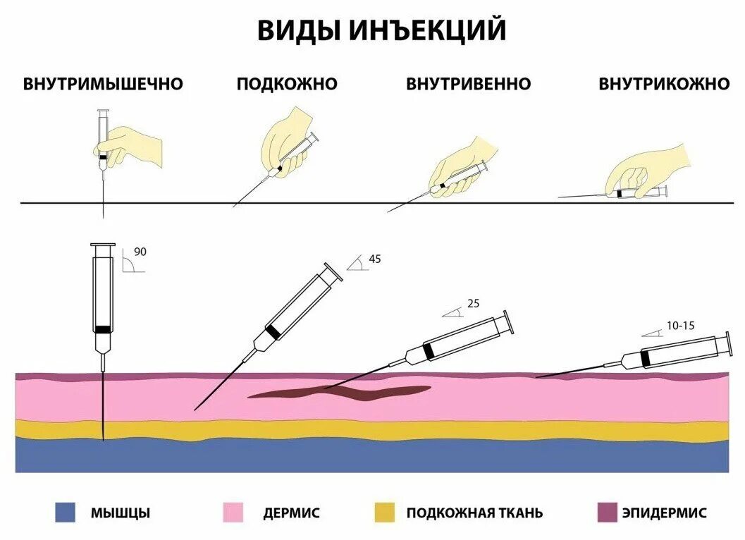 Градусы введения иглы