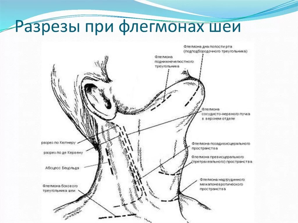 Операция абсцесс шеи. Разрезы для дренирования клетчаточных пространств шеи. Разрезы при нагноительных процессах шеи. Разрезы при подчелюстных флегмонах шеи. Дренирование флегмон шеи.