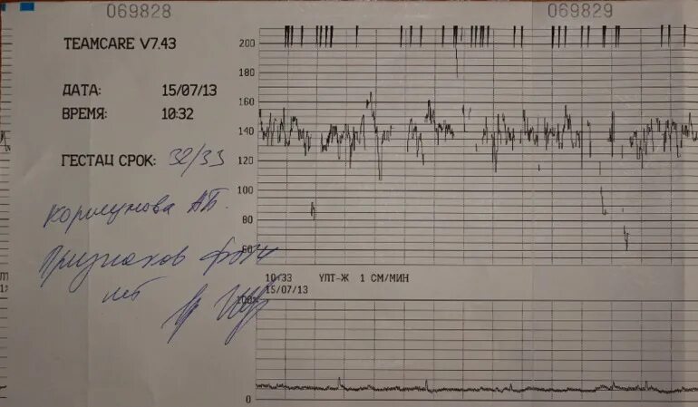 Схватки на 32. Плохое КТГ 37 недель беременности. Заключение КТГ В норме. Плохие показатели КТГ. Хорошее и плохое КТГ при беременности.