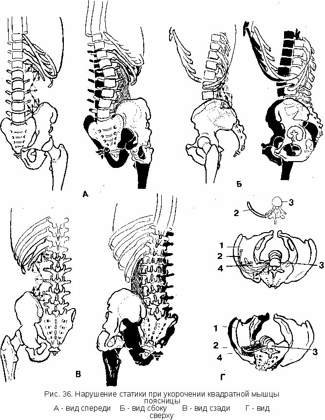 Укороченная квадратная мышца поясницы. Укорочение квадратной мышцы поясницы. Квадратная мышца поясницы вид сбоку. Укорочение квадратной мышцы спины.