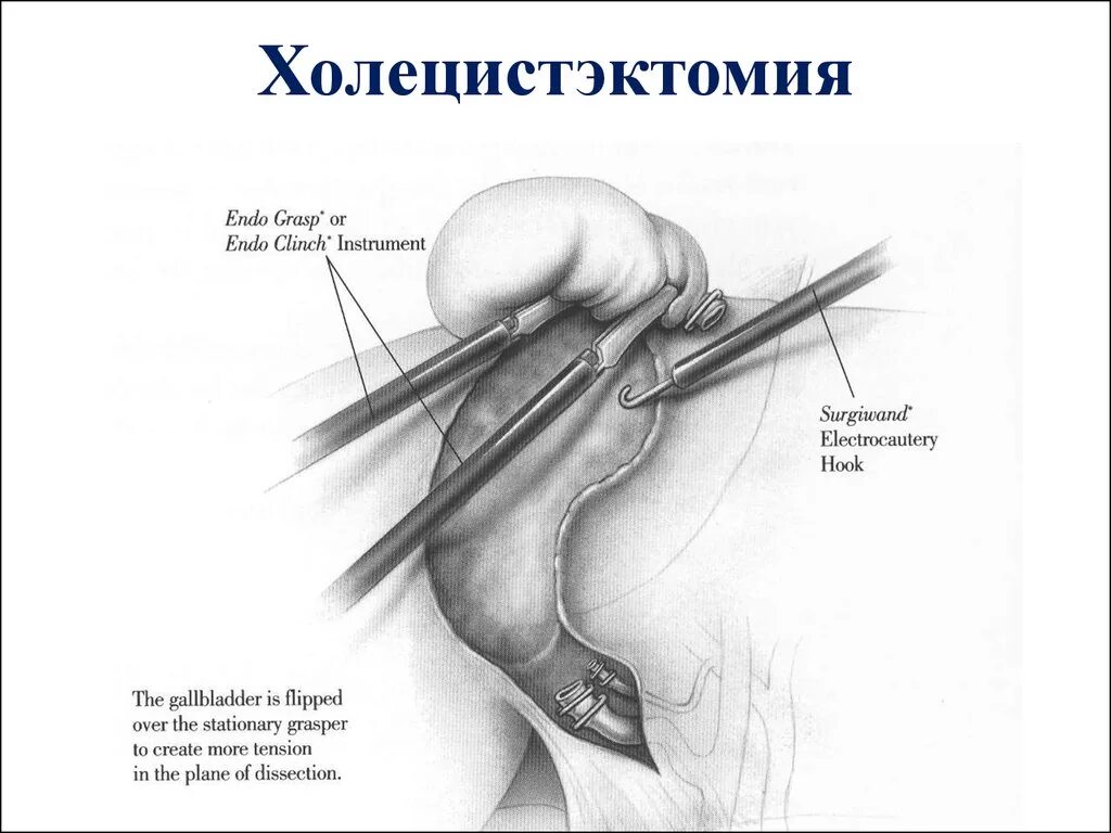 Холецистэктомия лапароскопия этапы. Оперативная хирургия холецистэктомии. Холецистэктомия (показания, техника операции).. Операция холецистэктомия ход операции. Этапы холецистэктомии