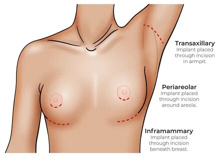 Breast implants can leave scars around the nipple or beneath the breast. 