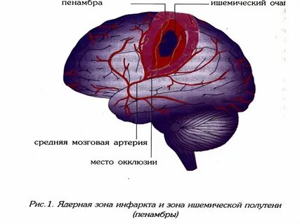Ишемический инсульт в бассейне средней мозговой