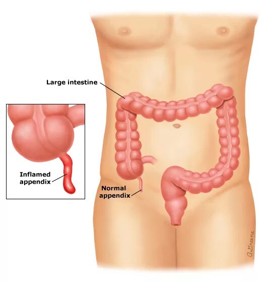 Аппендицит в организме. Анатомия человека органы аппендикс. Схема органов человека аппендицит. Строение органов аппендикс. Расположение аппендикса у человека анатомия.