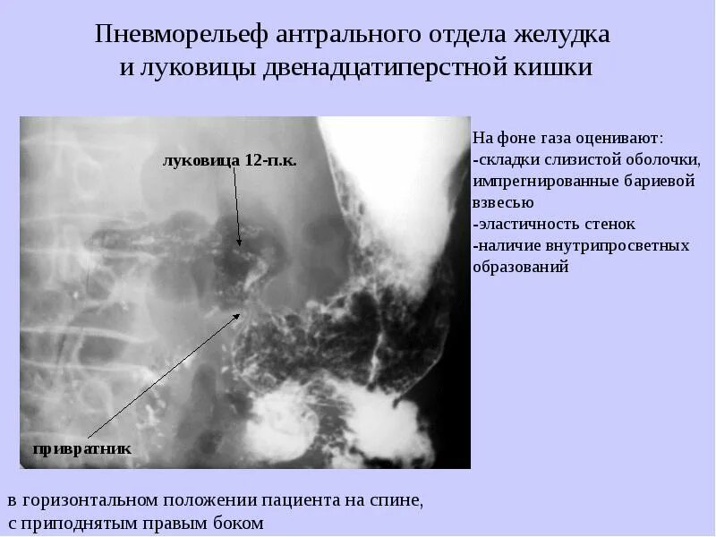 Гиперплазия слизистой оболочки желудка. Осложнения хронического атрофического гастрита. Кишечная метаплазия желудка гистология. Фовеолярная гиперплазия гистология. Фовеолярная гиперплазия гистология.