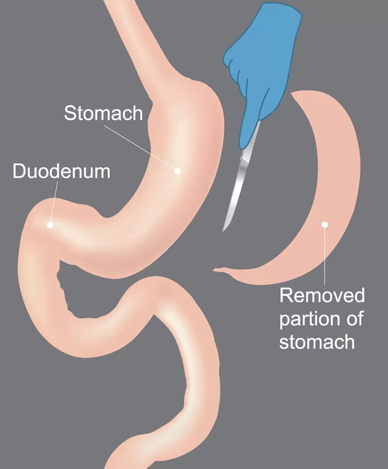 После удаления части желудка. Рукавная гастропластика желудка. Бариатрия резекция желудка. Бариатрическая продольная резекция желудка.