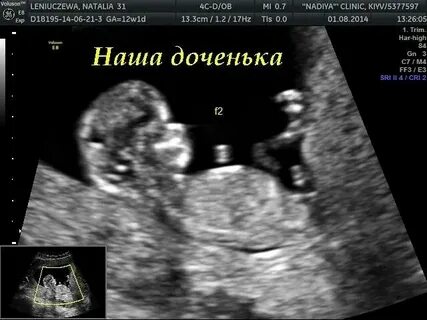 15 недель беременности можно ли узнать пол