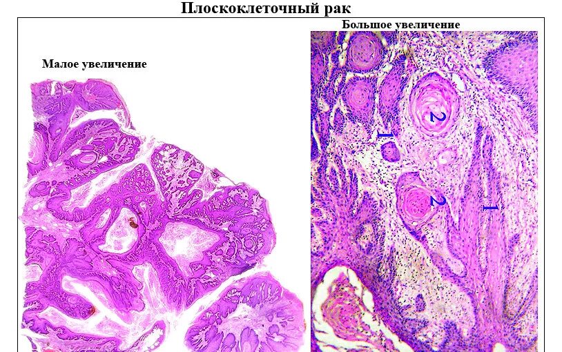 Плоскоклеточная карцинома легкого гистология. Плоскоклеточная карцинома шейки матки гистология. Плоскоклеточная карцинома матки микропрепарат. Плоскоклеточная карцинома микропрепарат. Стадии рака легких плоскоклеточный